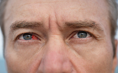 Man's sore eye with conjunctivitis. Closeup irritated infected red bloodshot eye