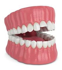 3d render of opened jaw with broken incisor upper tooth