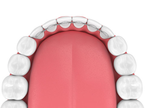 3d render of dental bonded retainer on lower jaw