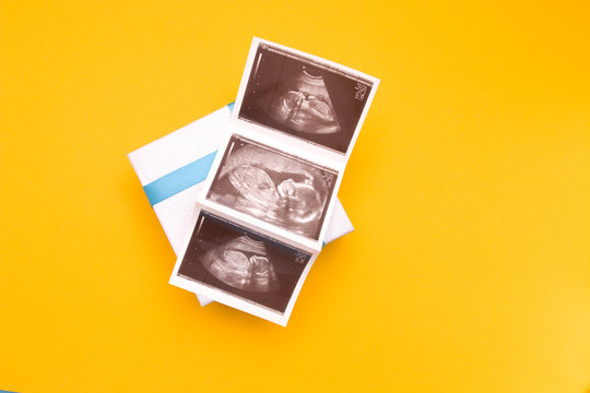 three snapshots of ultrasound on a silver box with a blue ribbon, yellow background copy space top view