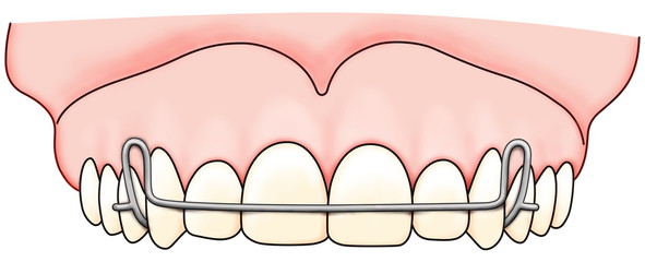 Removable orthodontic appliance is used after orthodontic treatment for retention © angelhid