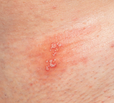 Skin Irritation In The Form Of Blisters And Inflammation