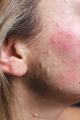 Obraz premium Real skin Biorevitalization. Traces of biorevitalization injections on the neck. Biorevitalization needle marks on the face