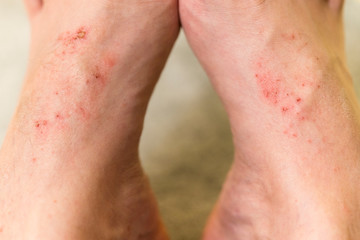 Naklejka premium Small eczema deposits on the toes.