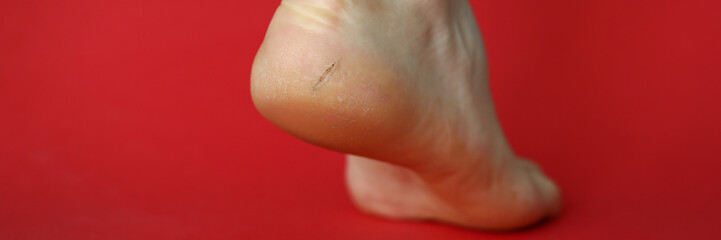 Close-up of heel of foot with bad skin covered with cracks. Female gam exposed to camera on lower view angle. Moisturizing cream advertisement concept. Isolated on red background