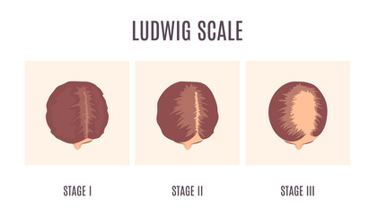 Female-pattern hair loss by Ludwig scale. 3 stages of baldness in women. Classification of alopecia shown on a head in top view. Beauty and health care concept. Medical vector illustration. - obrazy, fototapety, plakaty