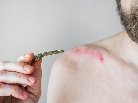 a man holds a metal clamp in his hand after surgery for a fracture of the collarbone. medical equipment concept