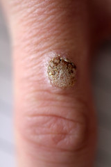 Obraz premium Wart on the hand finger. 