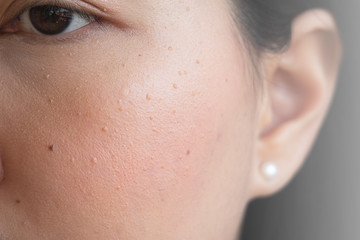 sian woman and problem on her skin, seborrheic keratosis. Which caused by too much exposing to the...
