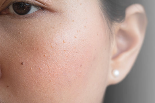 sian woman and problem on her skin, seborrheic keratosis. Which caused by too much exposing to the sun and not enough sunscreen protection,Freckles on Asian Woman Face, Skin Problems