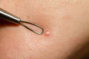 white abscess on the skin of the face with a cosmetic tool loop for cleaning blackheads close-up