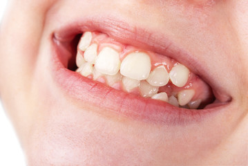 Closeup view on teenager mouth with permanent crooked teeth