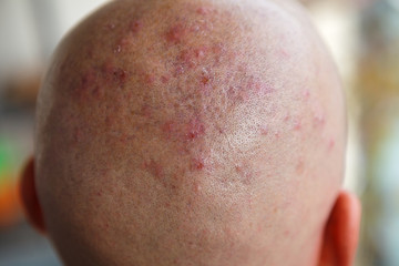 Man's shaved head with diseased skin, acne and eczema