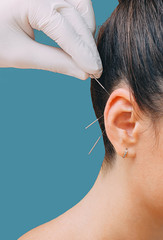 Hand of a reflexologist with an acupuncture needle near a woman's ear. Treatment of many diseases by ear acupuncture. Needles close-up on a blue background