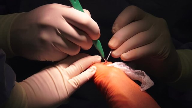 Hand surgeons perform a wide variety of operations such as fracture repairs, releases, transfer and repairs of tendons and reconstruction of injuries, rheumatoid deformities and congenital defects.