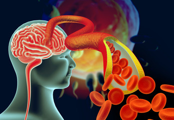Cholesterol plaque in artery with human brain anatomy. 3d illustration.