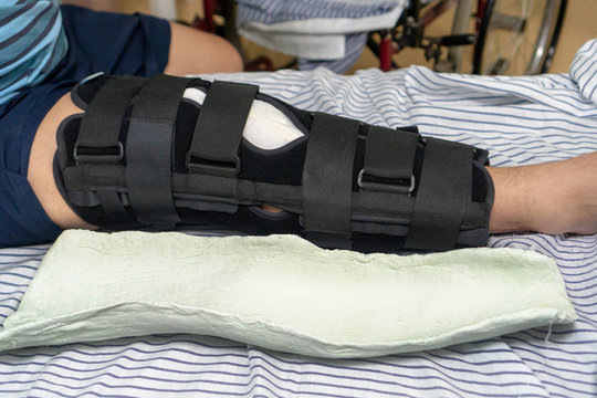 A man lies on a hospital bed in an orthopedic splint on the knee joint. Nearby lies gypsum, which was removed from his leg. Trauma of knee in brace. Knee joint retainer. An alternative to plaster on