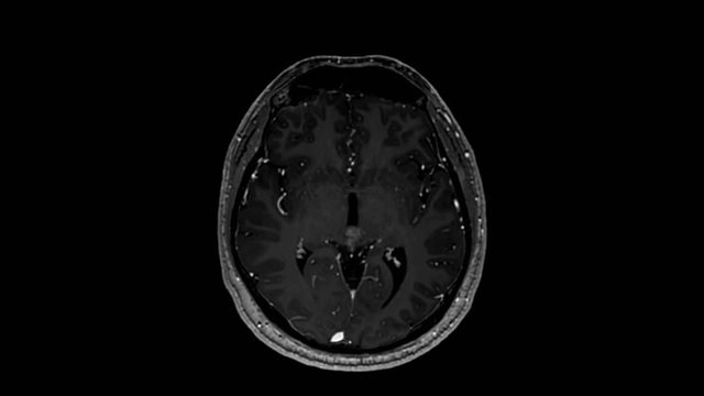 Human brain MRI scan, Gradient echo axial T1, infused Gadolinium, Imaging at 3T. Real brain scan.