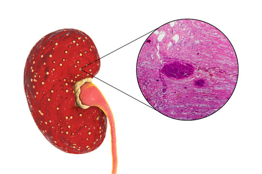 Acute pyelonephritis, 3D illustration showing gross morphology with focal small abscesses in kidney tissue and light micrograph showing histopathology of microabscesses