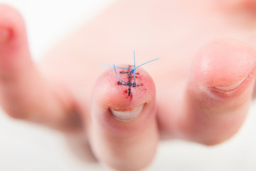 A deep wound is sewn on the middle finger of the hand