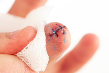 A deep wound is sewn on the middle finger of the hand