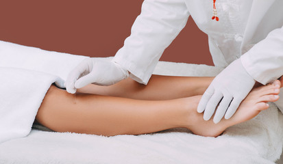 Reflexologist doing acupuncture to the patient. Needle therapy helps patients get rid of many...
