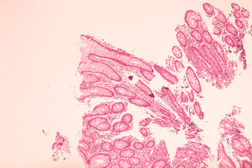 View in microscopic of ductal cell carcinoma, adenonocarcinoma from human breast cancer, tissue...
