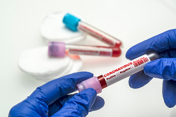 Coronavirus blood test .  Coronavirus positive blood in laboratory. 2019-nCoV Coronavirus originating in Wuhan, China