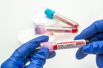 Coronavirus blood test . 2019-nCoV Coronavirus originating in Wuhan, China