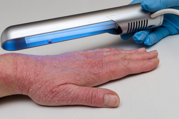 Treatment of skin diseases with narrow-band ultraviolet with a wavelength of 311 nm.
