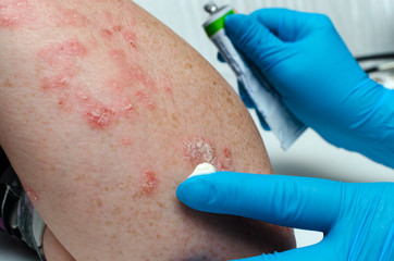 Treatment of psoriasis. A gloved doctor applies a medicated ointment to a patient s diseased skin.