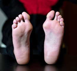 Fototapeta premium hallux valgus
