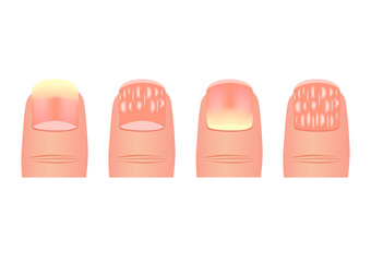 Onychomycosis or tinea unguium vector / nail disease / finger