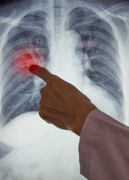 Doctor hand pointing at chest x-ray in computer monitor © Teeradej
