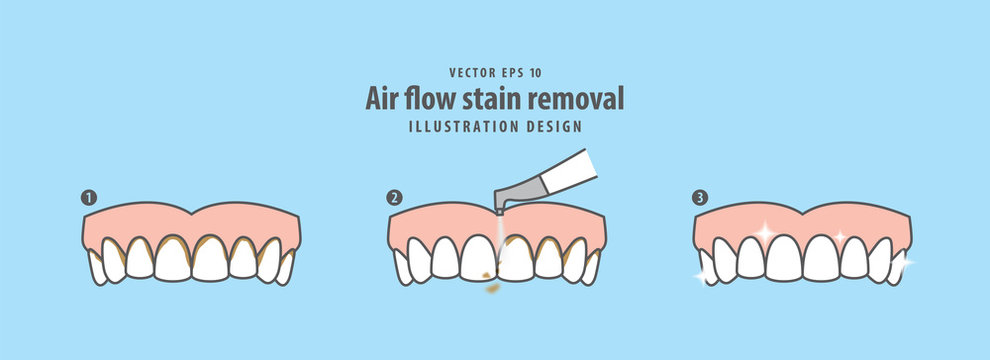 Air flow stain removal and teeth cleaning step (upper) illustration vector on blue background. Dental concept.