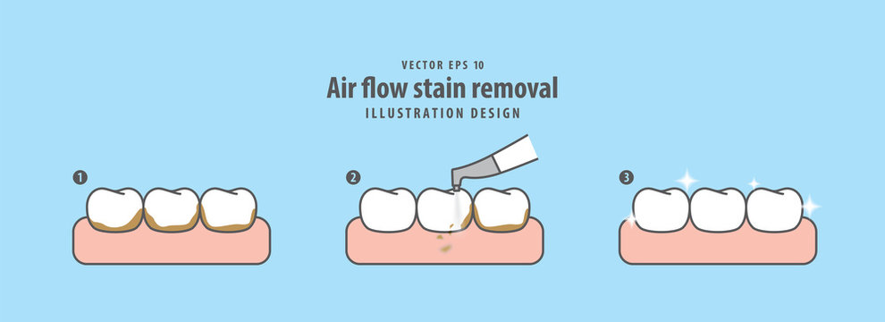 Air Flow Stain Removal And Teeth Cleaning Step Illustration Vector On Blue Background. Dental Concept.