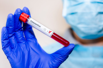 Medical laboratory assistant holding test tube with positive Coronavirus test blood sample.