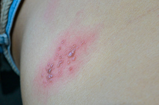 blisters caused by shingles on skin, herpes zoster