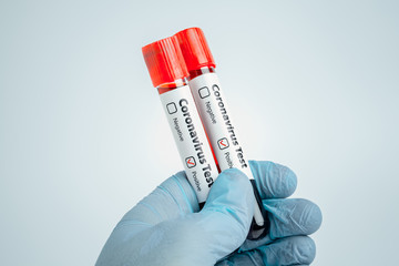 Obraz premium Scientist holding blood samples in test tubes with positive diagnosis result marked. Epidemic Mers-CoV Coronavirus researching and treatment concept.