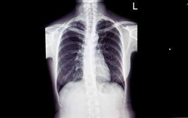 chest x-ray a human, Lung X-ray film of female patient in computer's monitor, Medical Technology and Science concept.