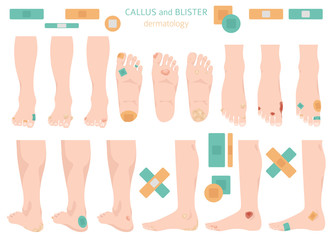 Callus, corn and blister feet and hands. Dermatology. Medical desease infographics collection - obrazy, fototapety, plakaty