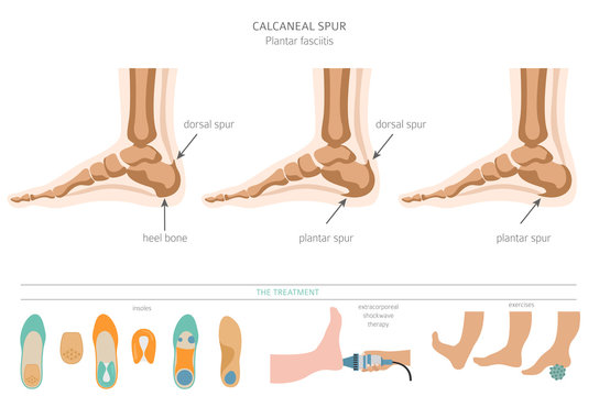 Dorsal spurring deals foot