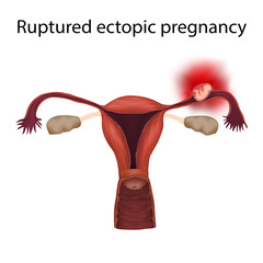 Ruptured ectopic pregnancy. Growing fetus ruptures fallopian tube. Medical anatomy illustration.