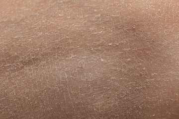 Fototapeta premium Very dry skin with evident exfoliation, extreme close up of dehydrated human skin