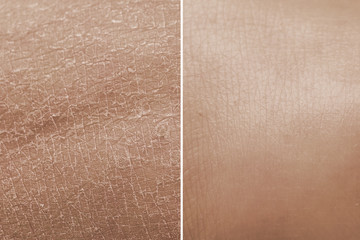 Skin before and after a treatment with moisturizing cream. Concept of anti-aging products