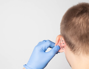 A plastic surgeon doctor examines a male patient s ear for an otoplasty operation. The concept of removing deafness, copy space - obrazy, fototapety, plakaty