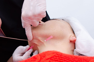 Mesotherapy face lift with needles