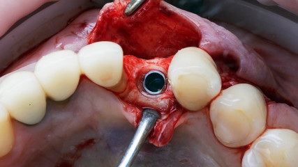 mounted implant, photo from the distal side