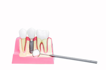 Implantology. Dental implants and human jaw model with dental mirror isolated on white background