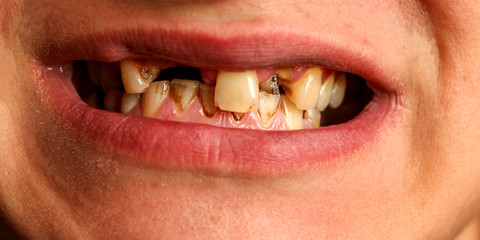 open mouth with broken, diseased teeth affected by caries and periodontitis. Steel pin in the gum for the installation of a dental crown. Smoker's teeth coated with nicotine plaque.